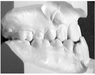 Functional Occlusion in the Dental Lab: Understanding the 3 Classes of ...